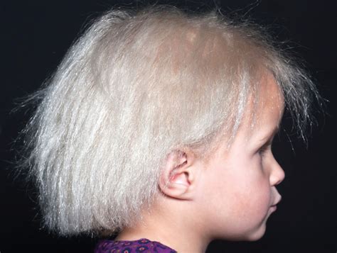 A Girl With Unruly Locks Molecular Genetics Makes A Diagnosis Of Uncombable Hair Syndrome The