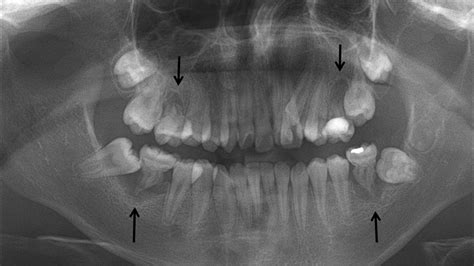 Panoramic Radiograph Of Patient 5 At The Age Of 12 Years All Permanent