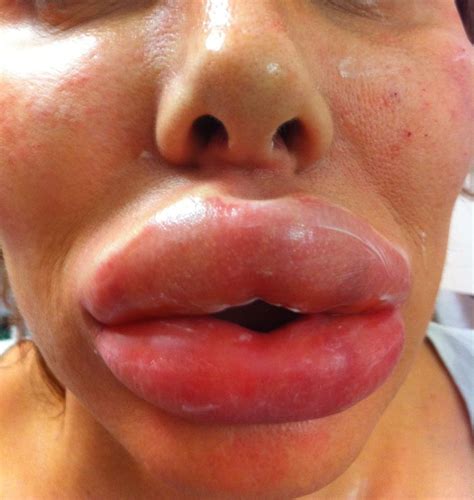 If left untreated, steph would have been in danger of losing her lips. Fillers - Why You Shouldn't Buy Them Over The Internet ...