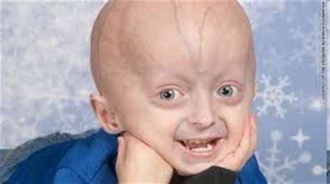 Adeal News Progeria Facts As Rare Genetic Condition Lite Review