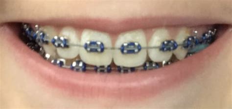 Navy Blue Braces Braces Colors Braces Teeth Colors Braces Tips