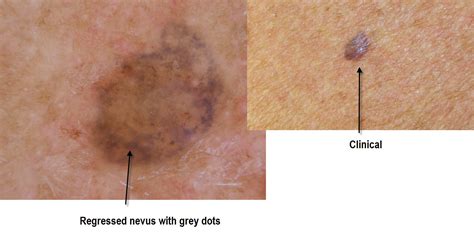 Dermoscopy Made Simple Benign Nevus