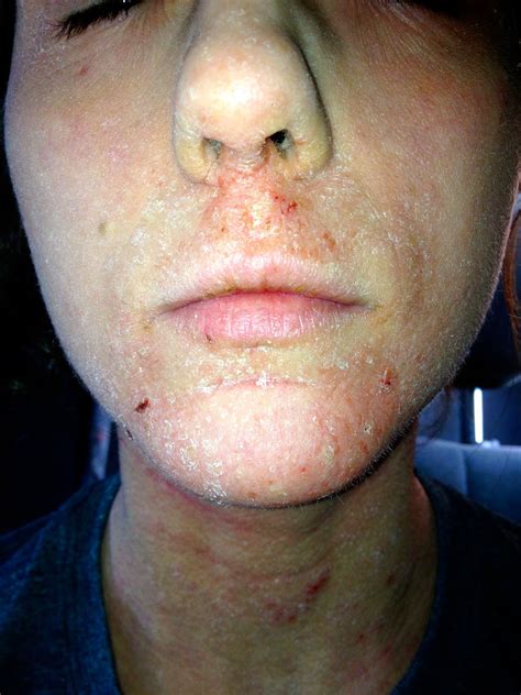 Scratching The Surface Of Topical Steroid Withdrawal Year 2 Month 2