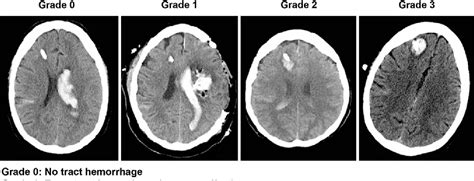 Figure 1 From Safety Of Intraventricular Hemorrhage Ivh Thrombolysis