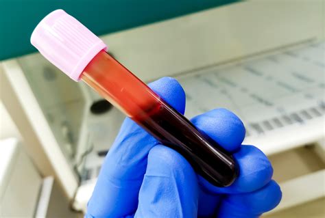 This Simple Test Could Detect Brinalexia Early