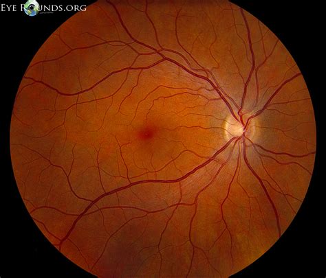 Retina Fundus Måling Sundhedscheck Af øjet Optikhuset