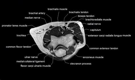 Mri Anatomy Of Elbow Axial Cross Sectional Anatomy Of Elbow Joint