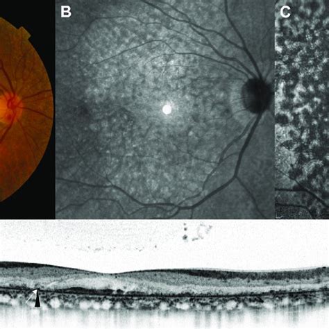 Fundus Images Of A Patient With Bietti Crystalline Dystrophy The