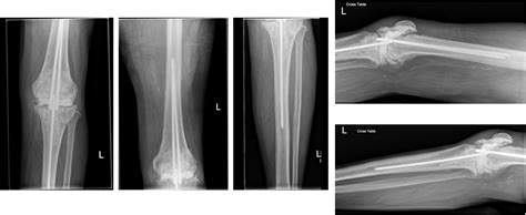 Knee Arthrodesis Is A Durable Option For The Salvage Of Infected Total