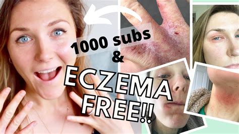 Eczema Cured How I Healed My Eczema Naturally 5 Eczema Healing Stages Project Reverse