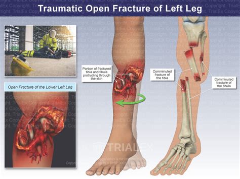 Traumatic Open Fracture Of Left Leg Trial Exhibits Inc