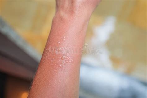 Burn Blister Stock Photo Image Of Hurt Skin Blister 38708260