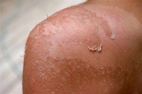 You Should Never Peel Sunburnt Skin Skin Doctor Warns