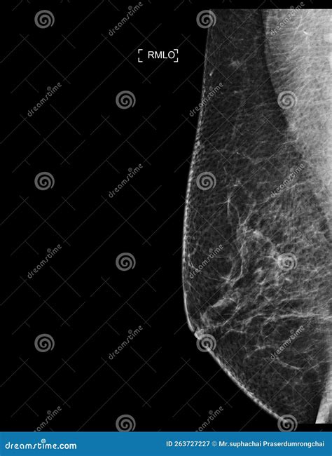 X Ray Digital Mammogram Or Mammography Of Both Side Breast Showing