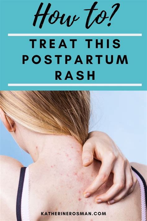 Postpartum Rash Symptoms Causes And Treatments