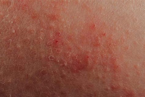 Eczema Signs Symptoms And Complications