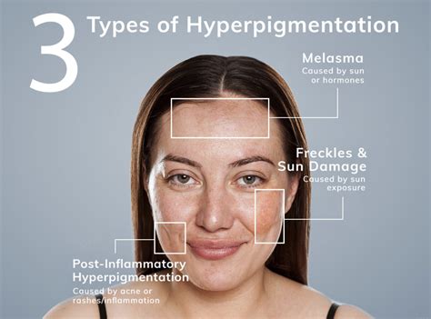 Hyperpigmentation Dermphysicians Of New England