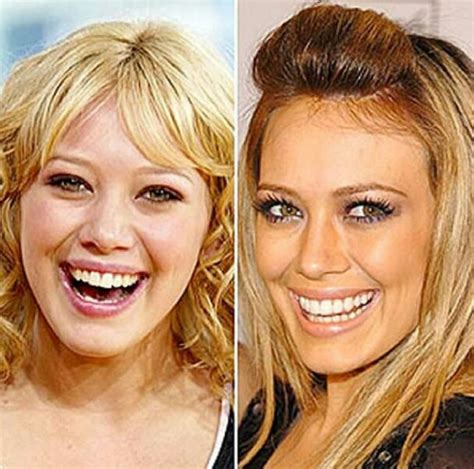 94 Best Images About Before And After Plastic Surgery On Pinterest