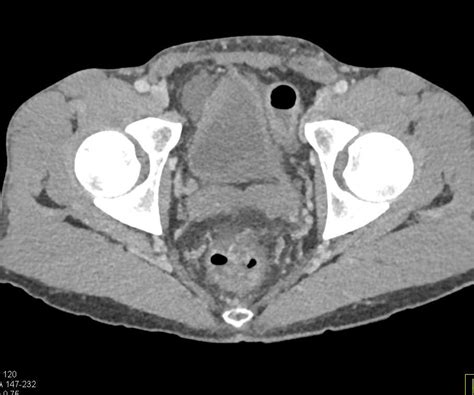 Multiple Liver Abscesses Liver Case Studies Ctisus Ct Scanning