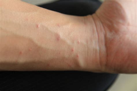 Scabies On The Hands Pictures Photos
