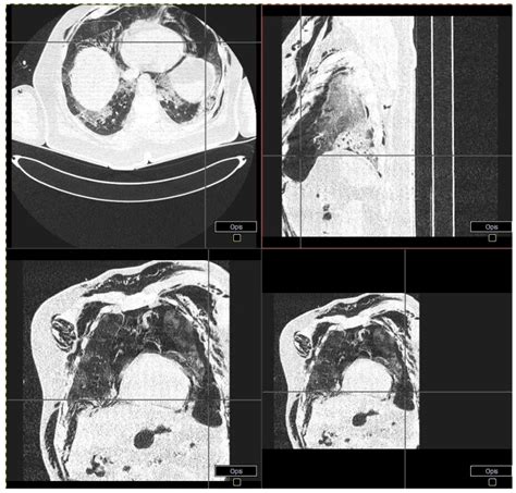 Maybe you would like to learn more about one of these? Spontaneous Pneumothorax in COVID-19 Patients Treated with ...