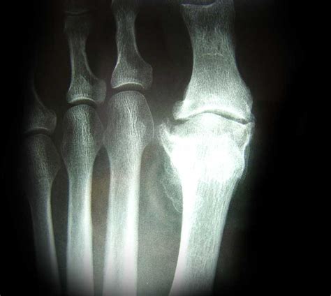 Arthritic Big Toe Sydney Foot And Ankle Surgeon