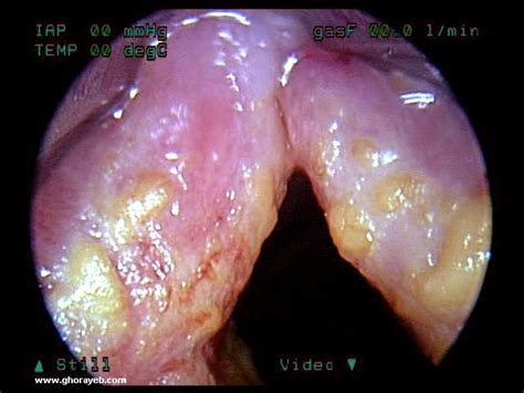 Leukoplakia is a condition where white patches or lesions appear in the mouth. Treatment For Diseases of Humen: Treatment For Laryngitis