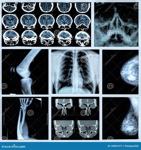 Radiography Of Human Bones Stock Image Image Of Chest 159841577