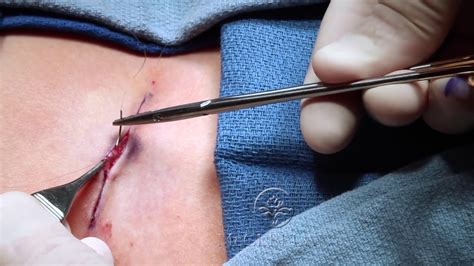 Live Surgery Running Subcuticular Suture What Is An Intracuticular Or