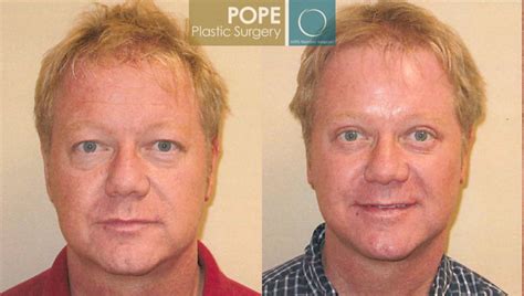 Facial Plastic Surgery For Men In Orlando Fl Dr George Pope