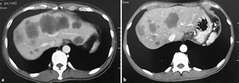 Abdominal Ct A Imaging Before Chemotherapy Multiple Liver Metastases