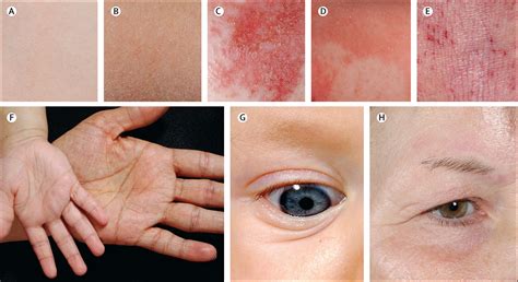 Atopic Dermatitis The Lancet