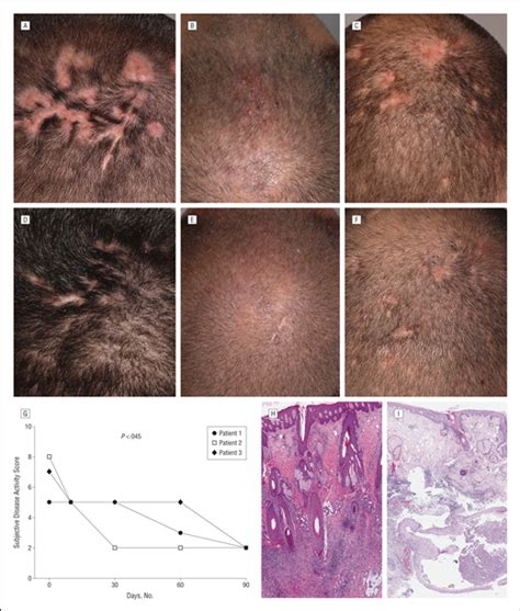3 Cases Of Dissecting Cellulitis Of The Scalp Treated With Adalimumab