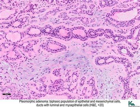 Pathology Outlines Pleomorphic Adenoma