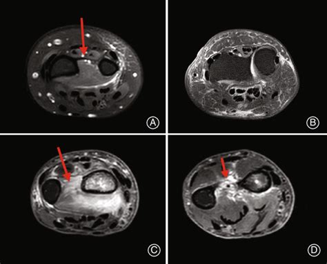 MRI Scans Of The Distal Radioulnar Joint A The Normal IOM In The Download Scientific Diagram