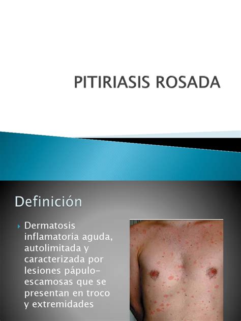 Pitiriasis Rosada