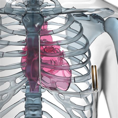 Aicds are common cardiac devices designed for both patient monitoring and therapy in case of ventricular tachycardia or fibrillation. Kardiologiske "device" | Indremedisineren