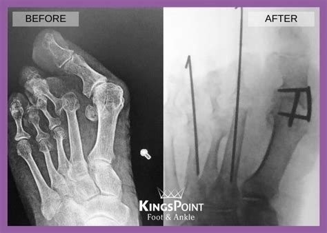 First Metatarsal Phalangeal Joint Mtp Arthrodesis Foot And Ankle