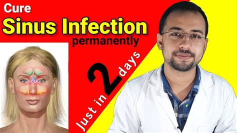 Cure Sinus Infection Just In 2 Days Naturally Sinusitis Treatment