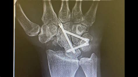 Arthroscopic Scaphoidectomy And Four Corner Fusion For Scaphoid Nonunion Advanced Collapse Snac