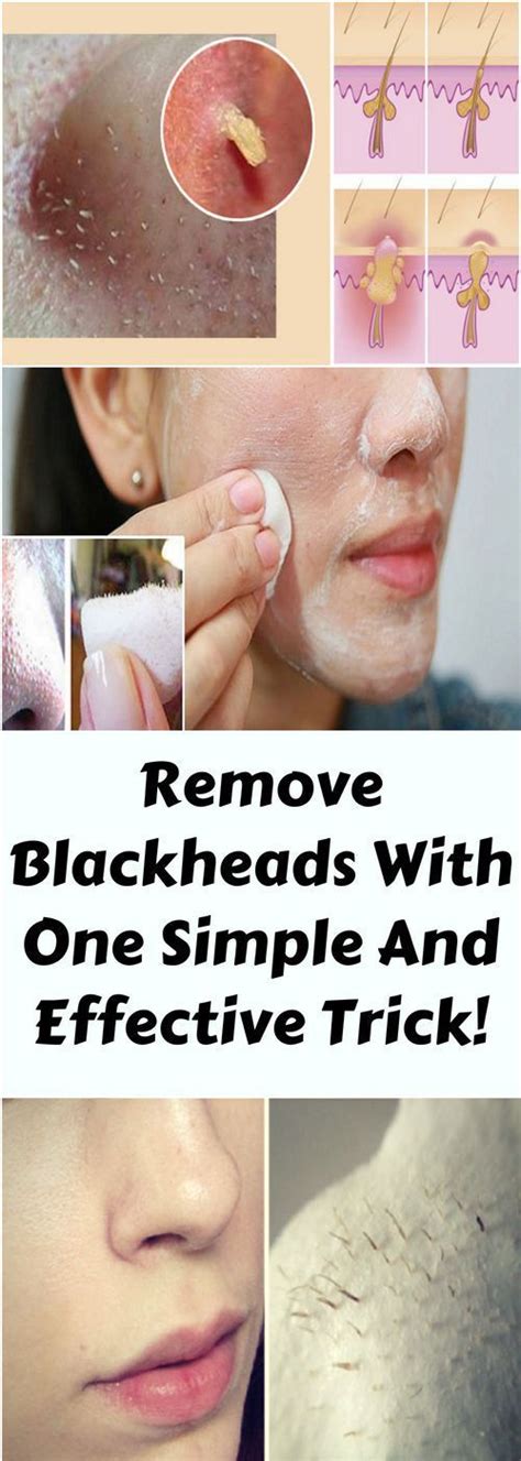 Remove Blackheads And One Simple And Effective Trick Lizy Style