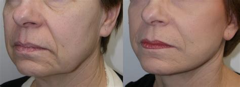 Getting older can unfortunately mean saggy skin. Cosmetic Surgery Clinic