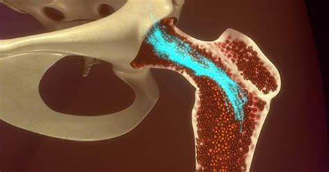 It may lead to greater than usual production of stem cells which then matures into any of the kinds of as the number of particular blood cells increases, cancer gets worse and results in the formation of tumours. Bone Marrow Cancer Stages - CancerOz