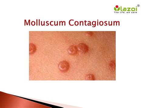 PPT Molluscum Contagiosum Symptoms Causes Diagnosis Treatment And Prevention PowerPoint