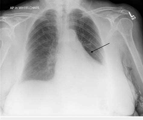 Left Basilar Consolidation Seen On Chest X Ray Download Scientific