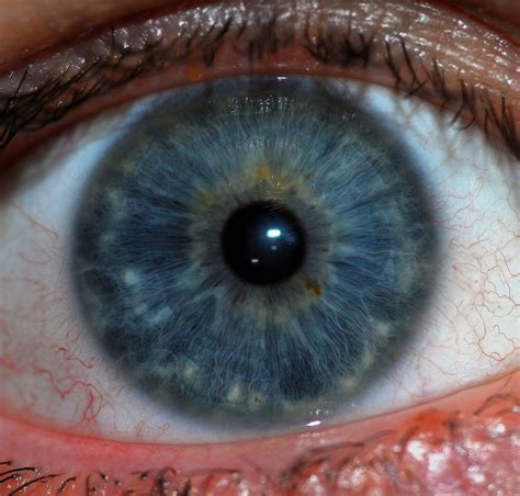 They could be anywhere from brown to pink in color this type of mar or discoloration in the eye is generally called a discolored tumor, although in reality they are not harmful. Iris (anatomy) - Wikipedia