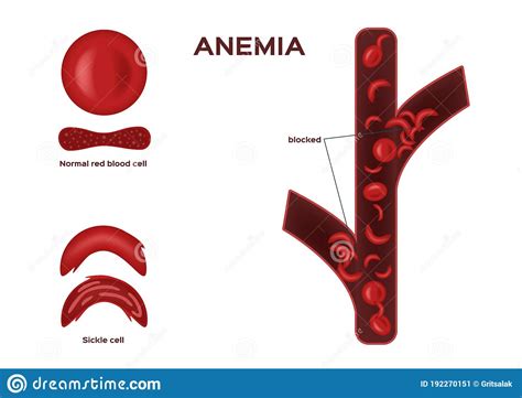 Normal Red Blood Cell And Sickle Cell Vector Anemia Stock Vector