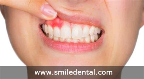 Do You Suffer From Gum Pain Smile Dental