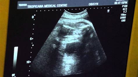 38 weeks pregnancy ultra scan youtube
