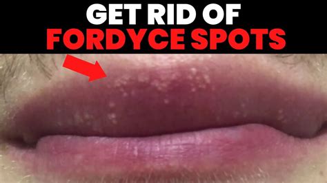 How To Get Rid Of Fordyce Spots On Your Lips Infoupdate Org